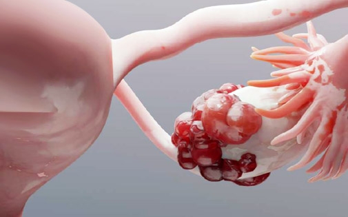 Çikolata Kisti Tedavisi