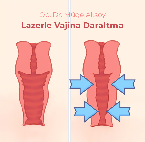 Lazerle Vajina Daraltma Ankara