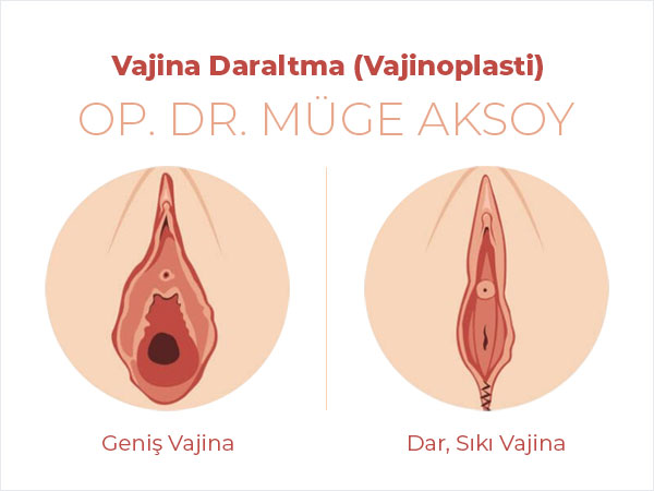 Vajina Daraltma (Vajinoplasti) Ankara